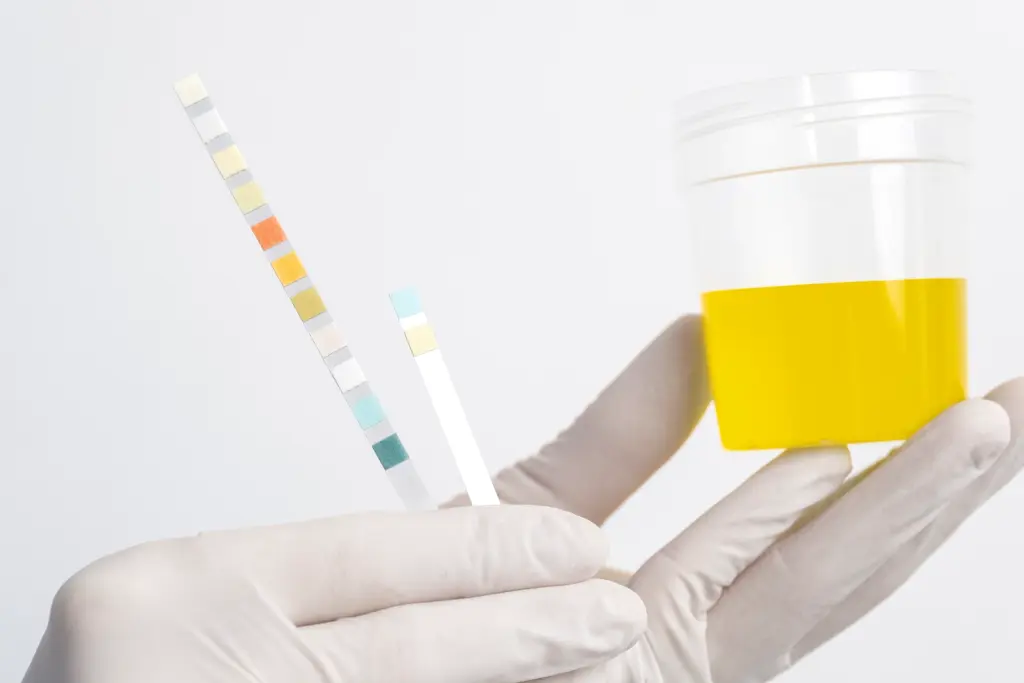 What does protein in urine mean during pregnancy 2 What protein in urine means during pregnancy