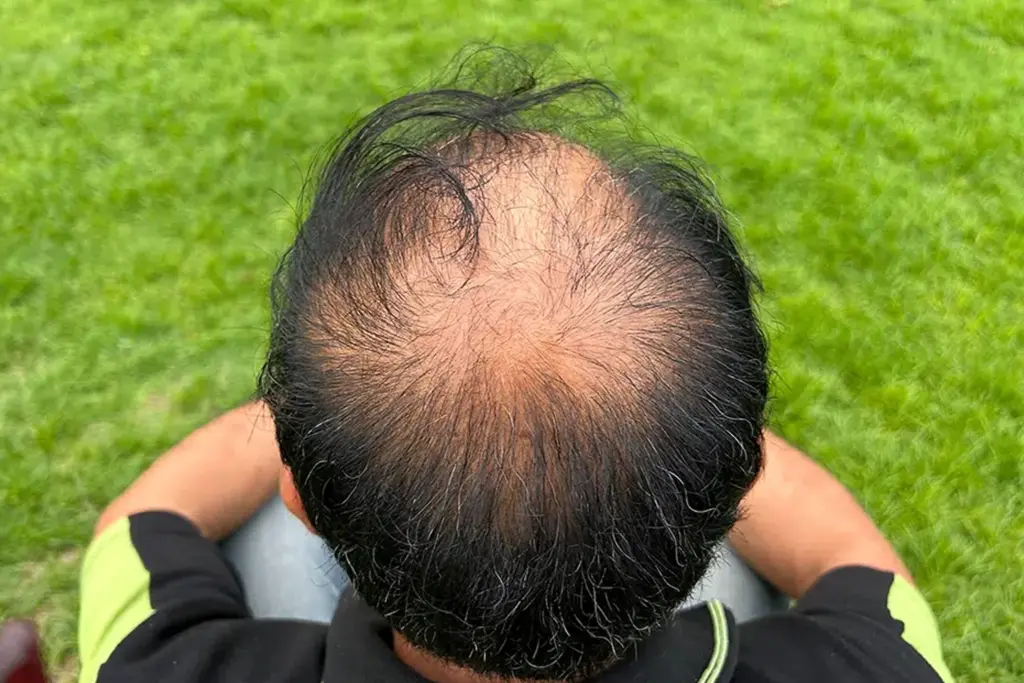 Androgenetic alopecia: Early signs of pattern baldness you shouldn’t ignore