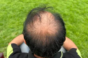 Androgenetic alopecia: Early signs of pattern baldness you shouldn’t ignore
