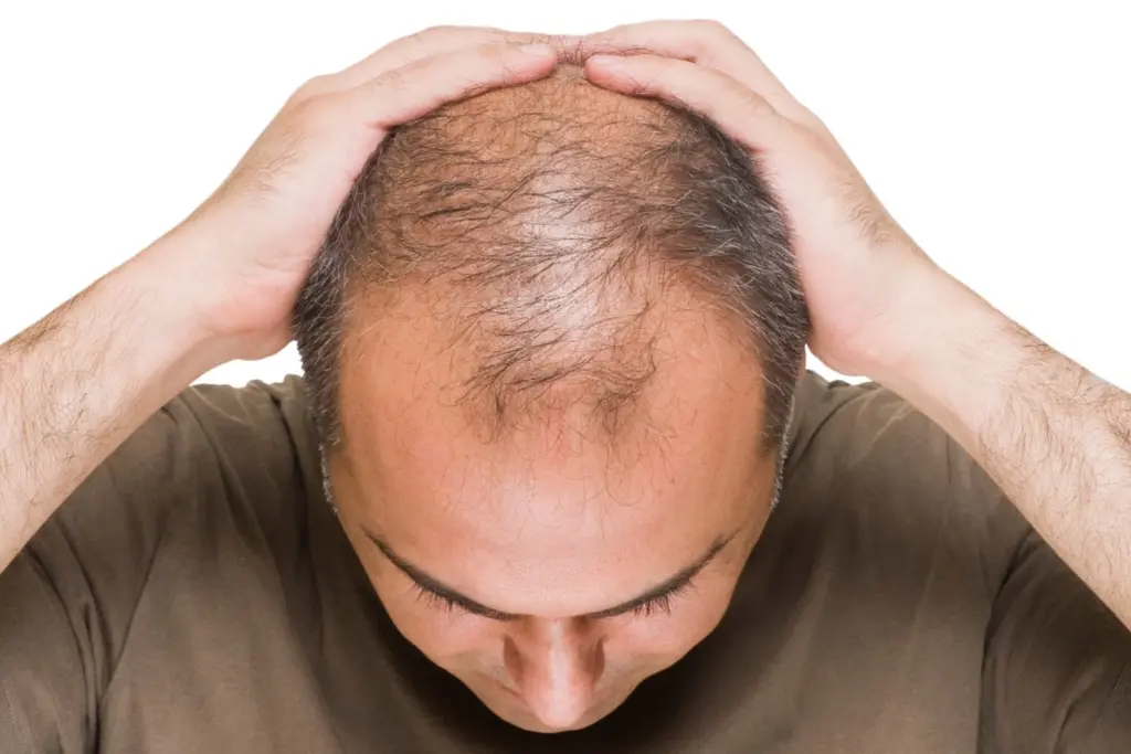 Androgenetic alopecia: Early signs of pattern baldness you shouldn’t ignore