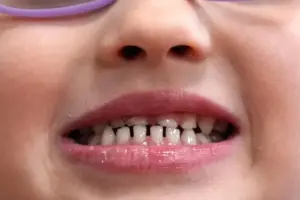 FDA tightens rules on fluoride supplements for kids, citing limited benefits and safety questions