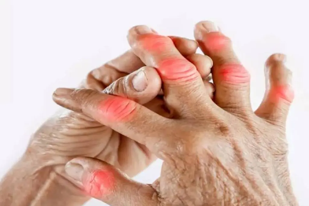 Can you prevent arthritis? What science says 2 Can you prevent arthritis? What science says