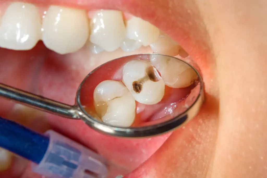 What causes tooth decay? Warning signs and prevention tips