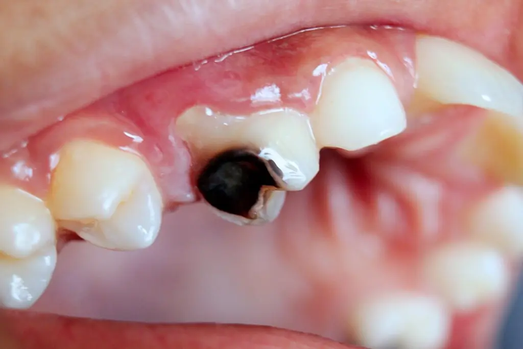 What causes tooth decay? Warning signs and prevention tips