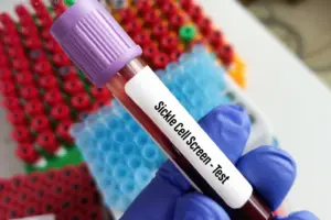 Study finds stem cell transplants deliver breakthrough in paediatric sickle cell