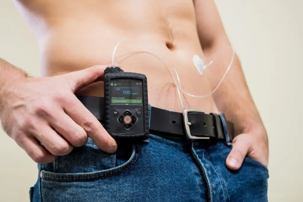 Insulin pumps for diabetes: How they work and who needs one 1 Insulin pumps for diabetes How they work and who needs one