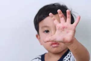 South Carolina measles outbreak surges past 300 cases; officials warn of more exposures