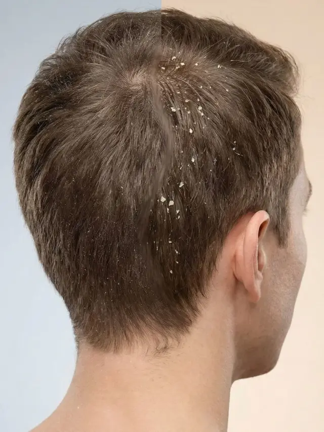 Dandruff: dry vs oily — different fix