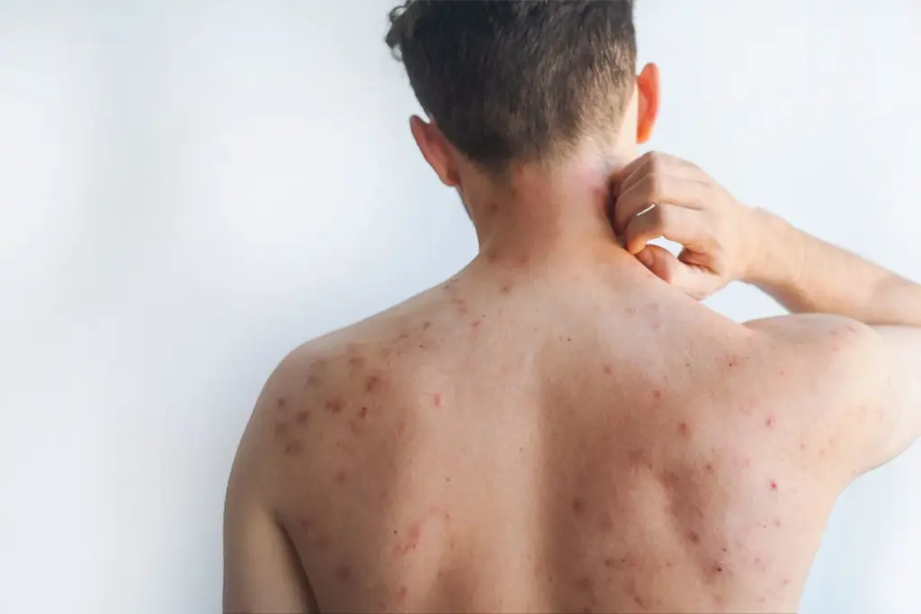Measles outbreak hits north London schools and nursery, over 60 cases reported 1 Measles outbreak hits north London schools and nursery, over 60 cases reported