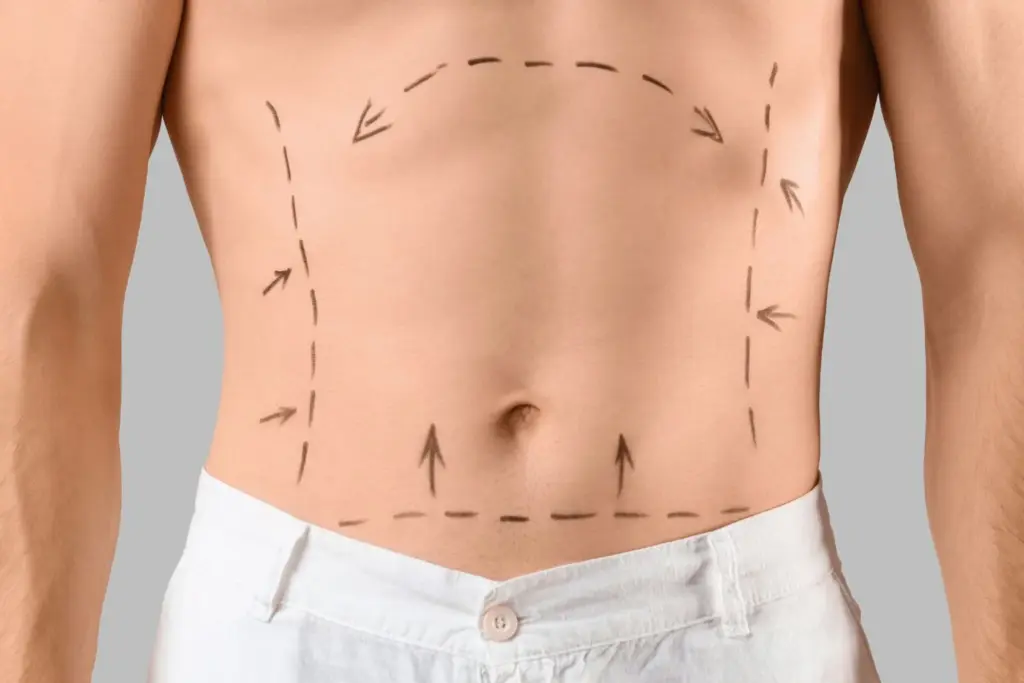 Abdominoplasty guide What a tummy tuck is and what to expect
