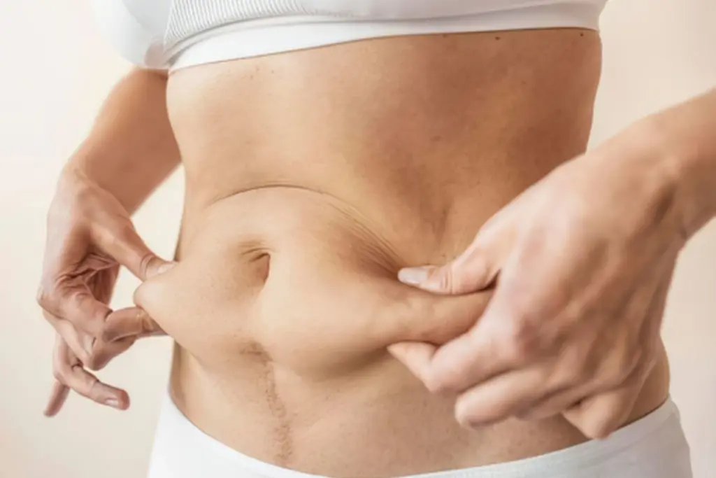 Abdominoplasty guide What a tummy tuck is and what to expect
