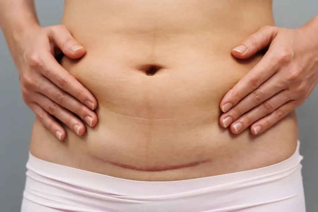 When do you need a C-Section What to expect during surgery