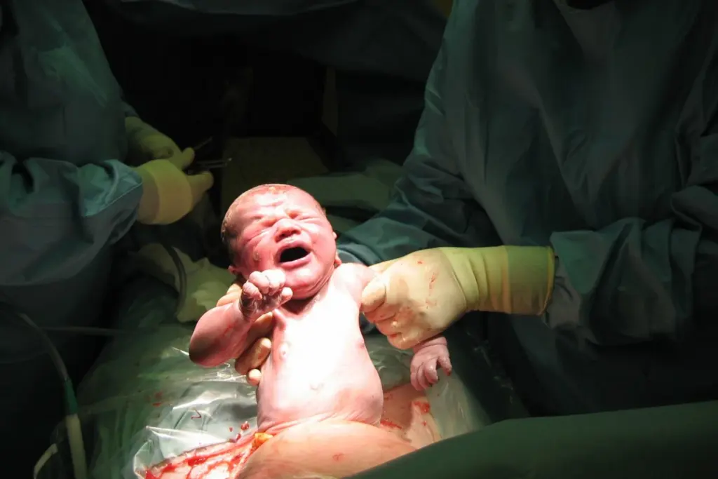 When do you need a C-Section What to expect during surgery