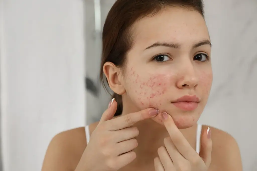 How to build a skincare routine for acne-prone skin 2 How to build a skincare routine for acne-prone skin