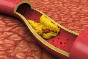 FDA approves first daily oral drug to lower bad cholesterol